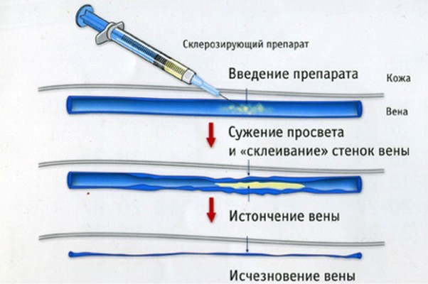 процедура склеротерапии