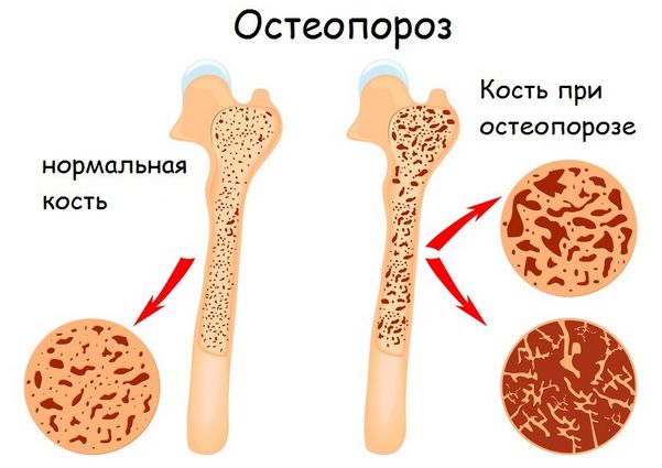 вид костей при остеопорозе