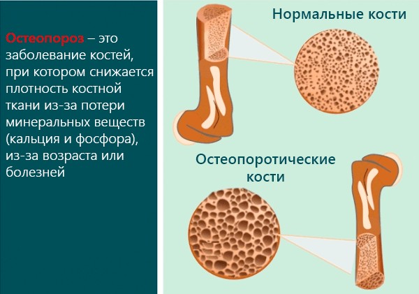 инфографика по остеопорозу