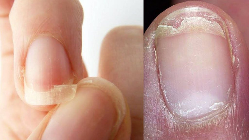 ТОП-17 причин, почему гель лак отслаивается от натурального ногтя